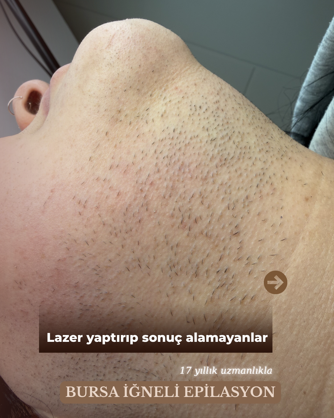 Yüzde İğneli Epilasyon 