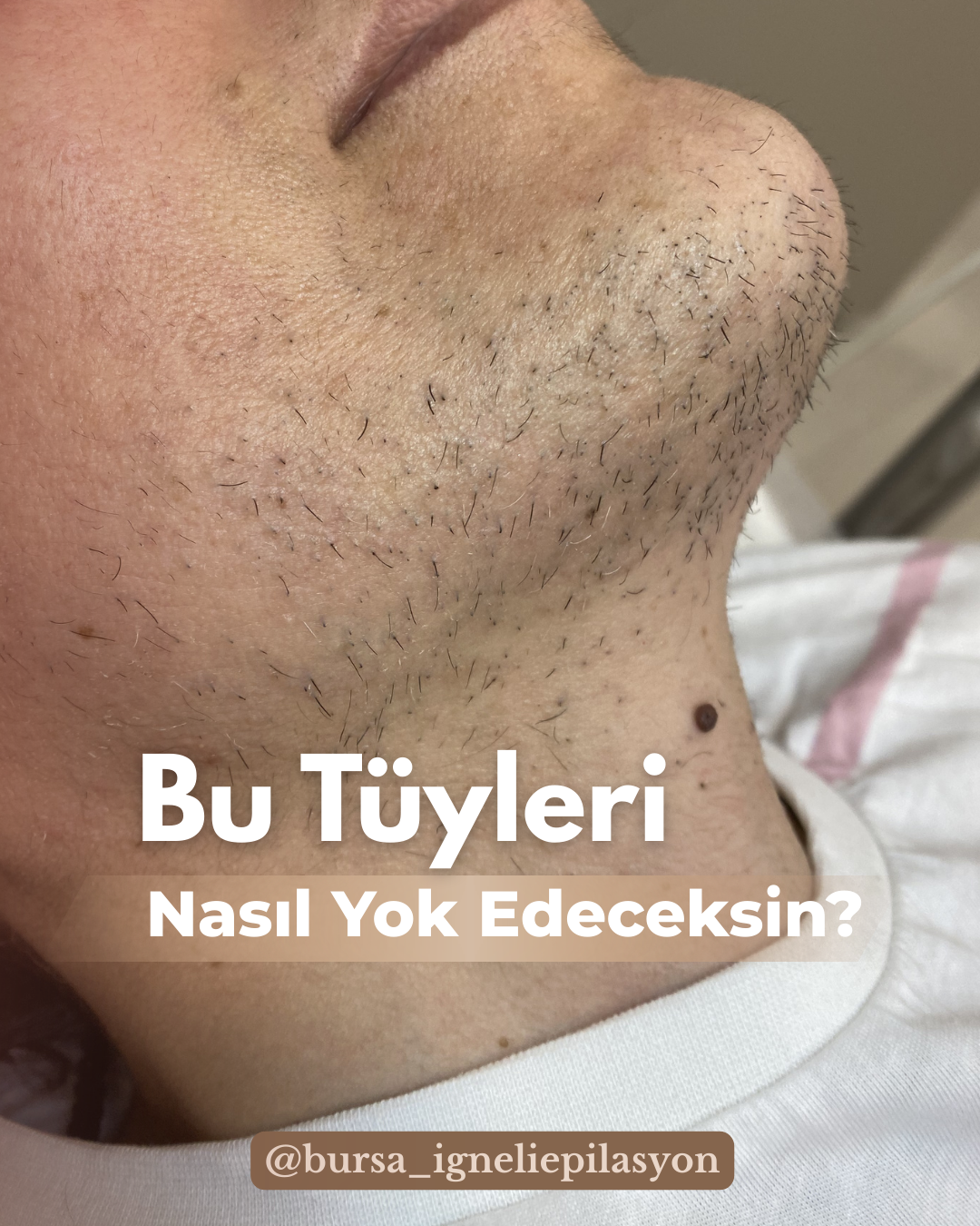 Neden İğneli Epilasyon Yaptırmalısın?