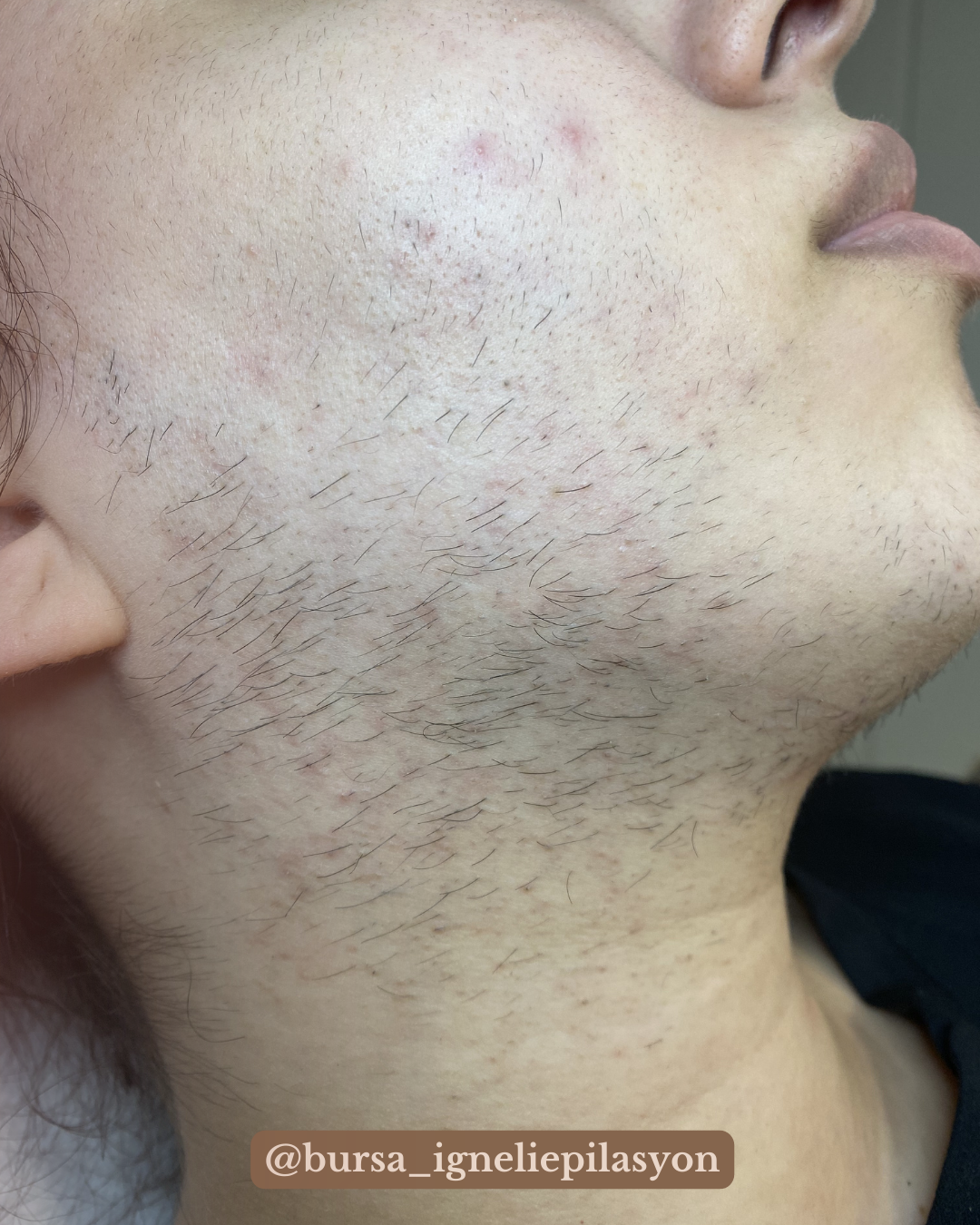 Neden İğneli Epilasyon Yaptırmalısın?