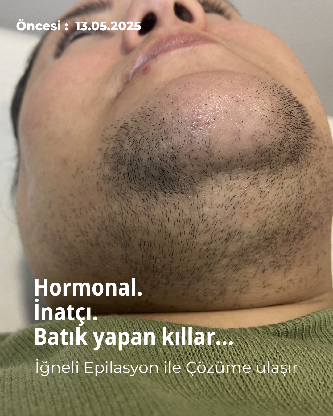 Bursa İğneli Epilasyon: 1 Yılda Elde Edilen Kalıcı Sonuç Öncesi