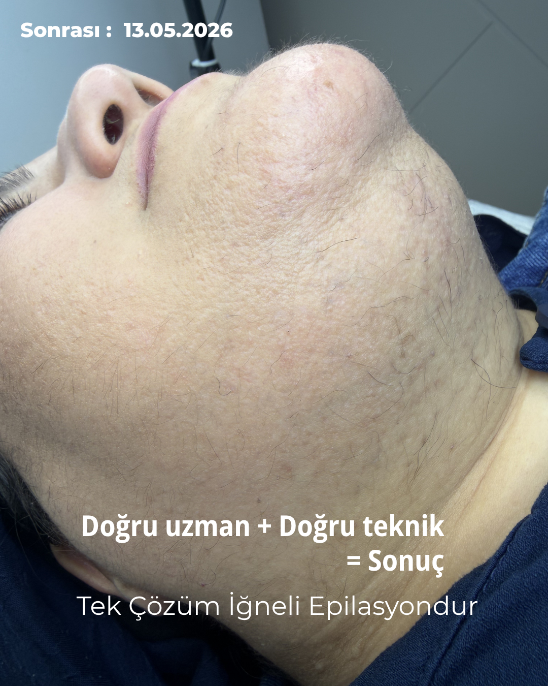 Bursa İğneli Epilasyon: 1 Yılda Elde Edilen Kalıcı Sonuç - Sonrası