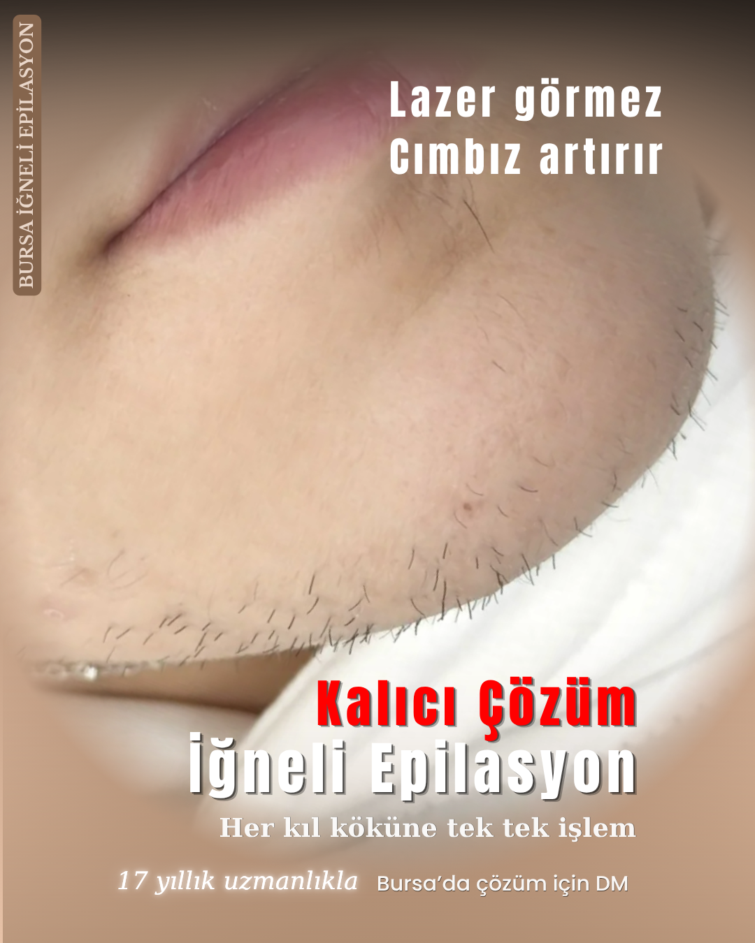Çene, Bıyık ve Yüz Tüylerinde Kalıcı Çözüm | Bursa Yüz Bölgesi İğneli Epilasyon