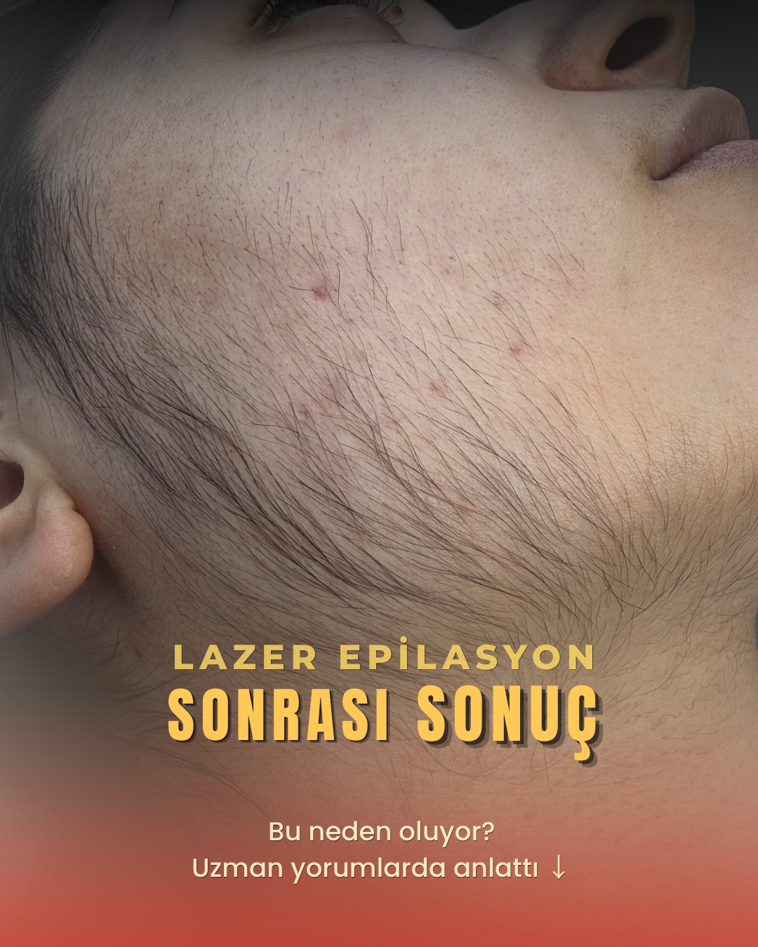 Lazer Epilasyon Sonrası Tüylenme Neden Artar? | Bursa İğneli Epilasyon Çözümü