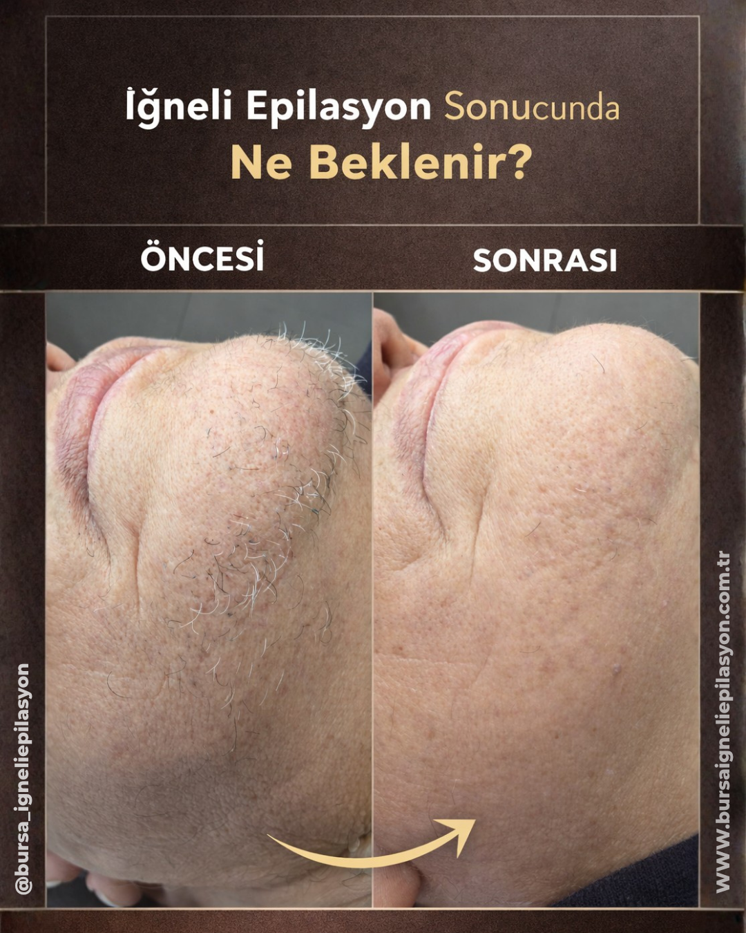 İğneli Epilasyon Sonrası Ne Beklenir? Öncesi Sonrası Gerçek Sonuçlar