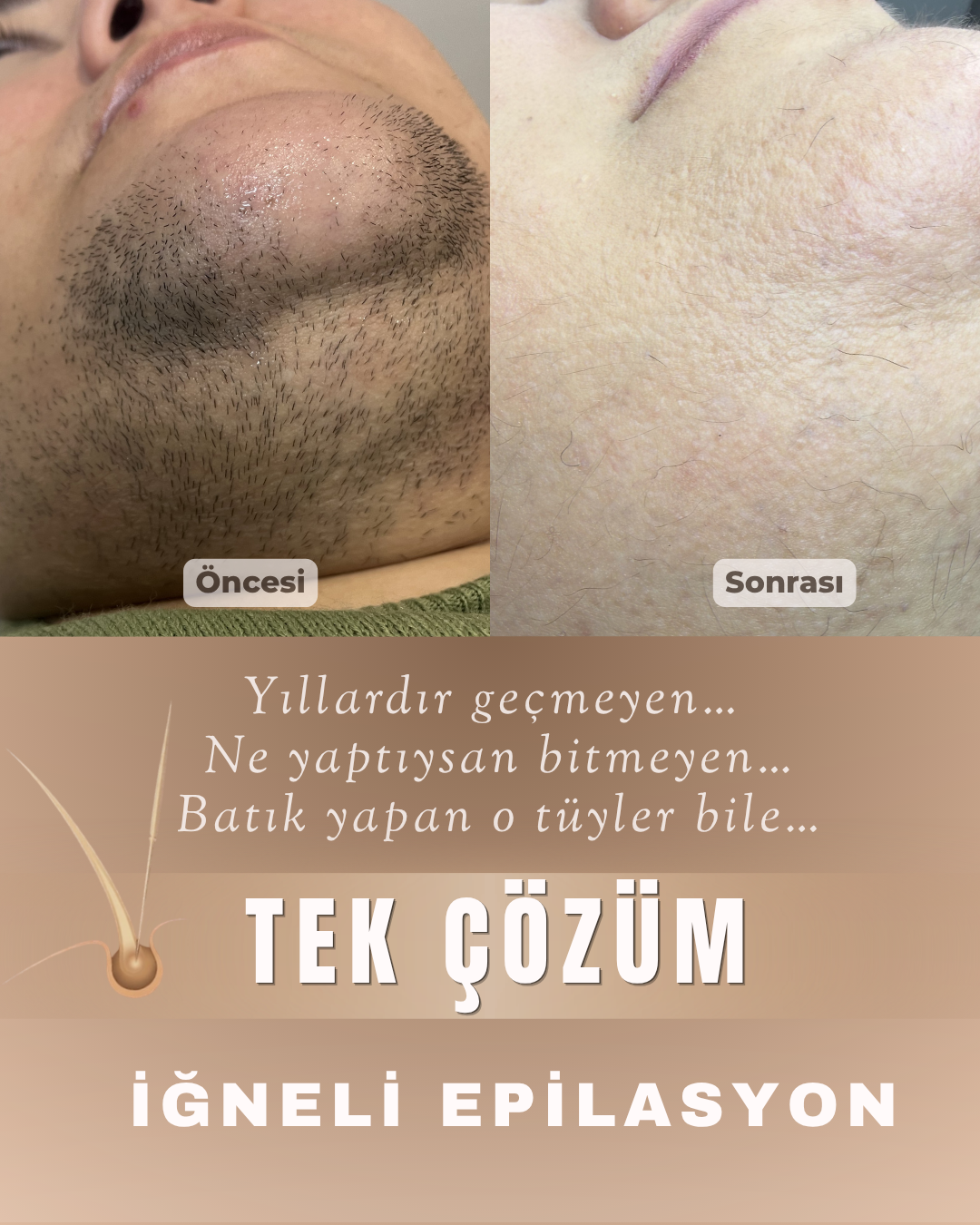 Yüzde Geçmeyen Tüyler İçin Kalıcı Çözüm | İğneli Epilasyon Öncesi Sonrası