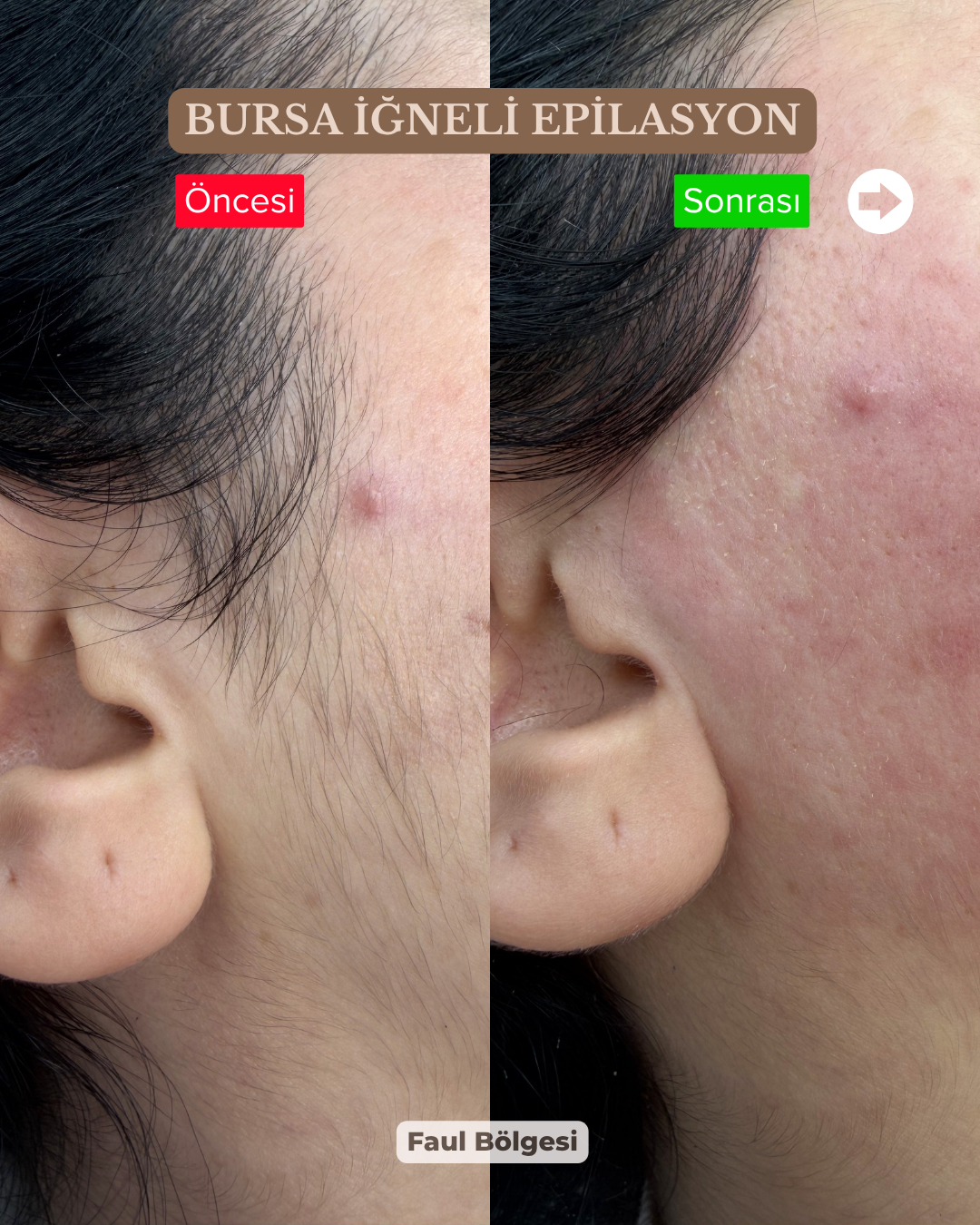Faul Bölgesi İğneli Epilasyon Öncesi Sonrası | Bursa Kalıcı Çözüm