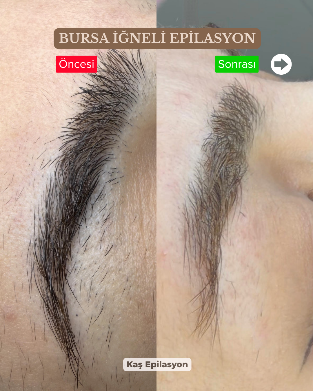 Kaş Çevresi İğneli Epilasyon Sonuçları | Öncesi Sonrası Gerçek Uygulama
